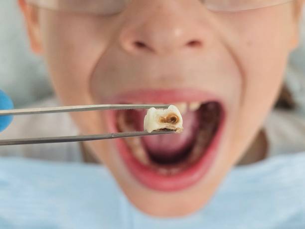 Best Emergency Dental Care for Broken or Chipped Teeth in Wells, MN